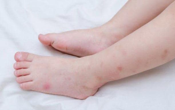 Sốt Xuất Huyết Trẻ Em: Dấu Hiệu Sớm, Chăm Sóc & Phòng Ngừa